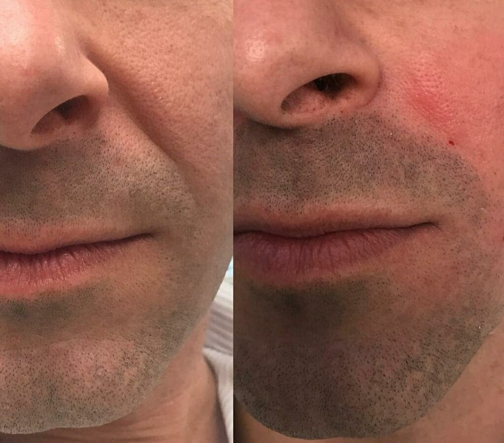 Retinal Shot - booster coreano