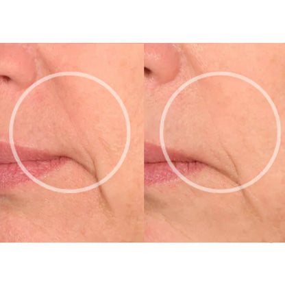 Kit Lift Care® - Sorriso